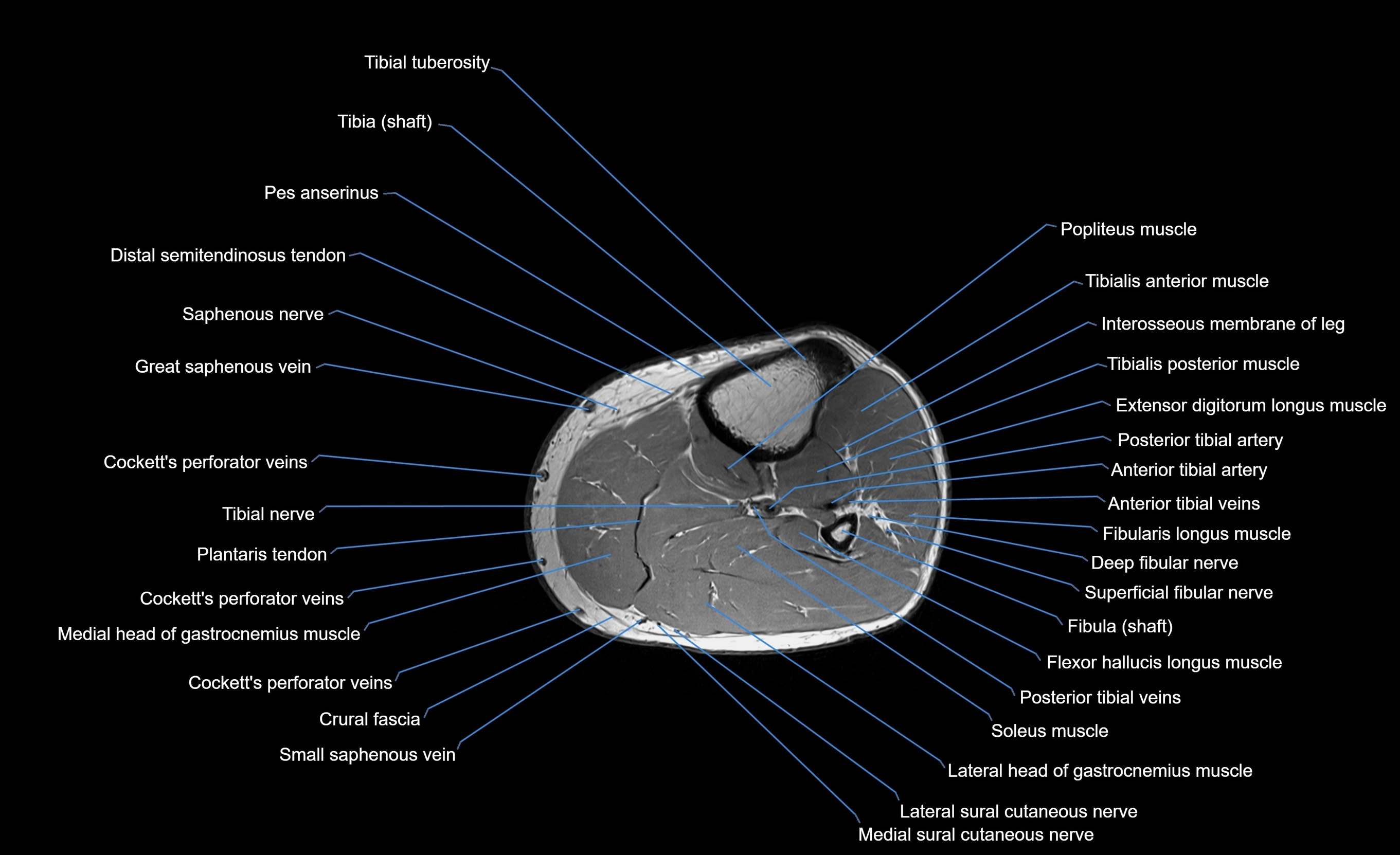 MRI lower leg axial cross sectional anatomy 3T  radiology  image-img-00001-00029.webp